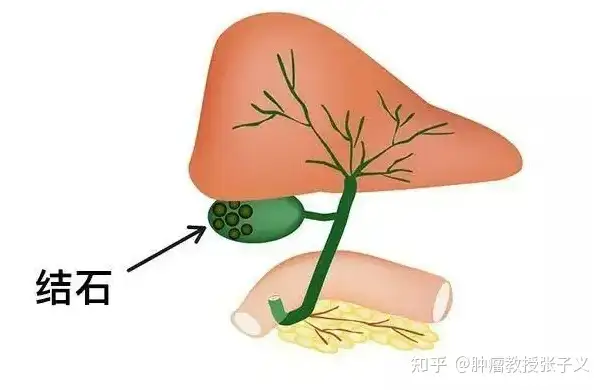 得了胆结石，身体会有这几个表现，一定要注意(图1)