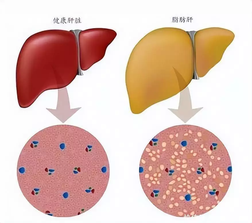 4类食物建议少吃,或加速肝硬化,真假?肝硬化患者(图7)