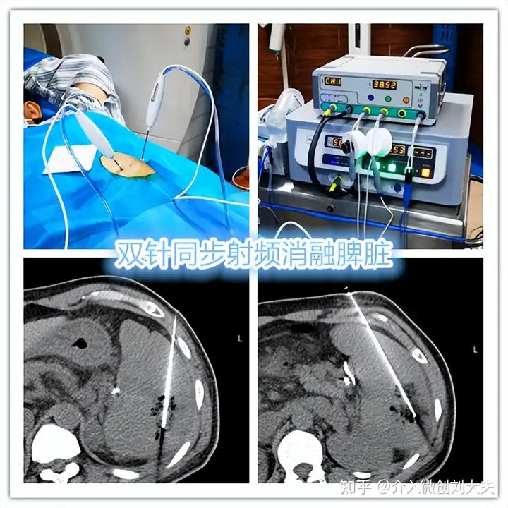 脾功能亢进微创治疗不开刀：PSE+RFA(图4)