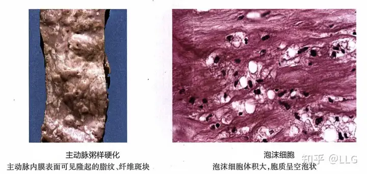 肾脏的主要几个病变(图1)