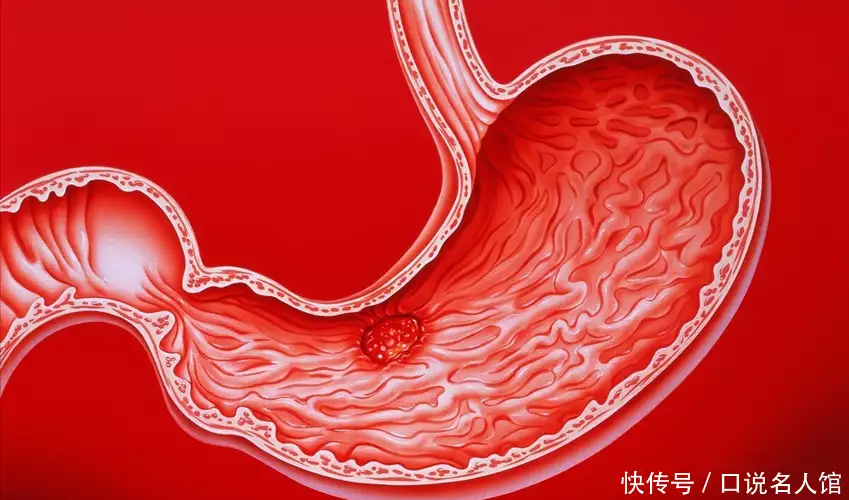 科普 | 幽门螺旋杆菌在疾病中有何作用，感染此(图17)