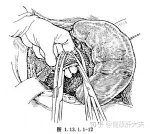 肝硬化导致的脾大该如何治疗？(图5)