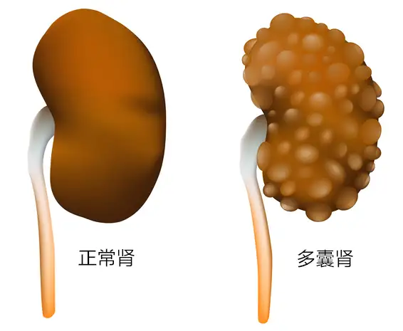 多囊肾病为何如此高发？后代该如何进行预防？(图1)