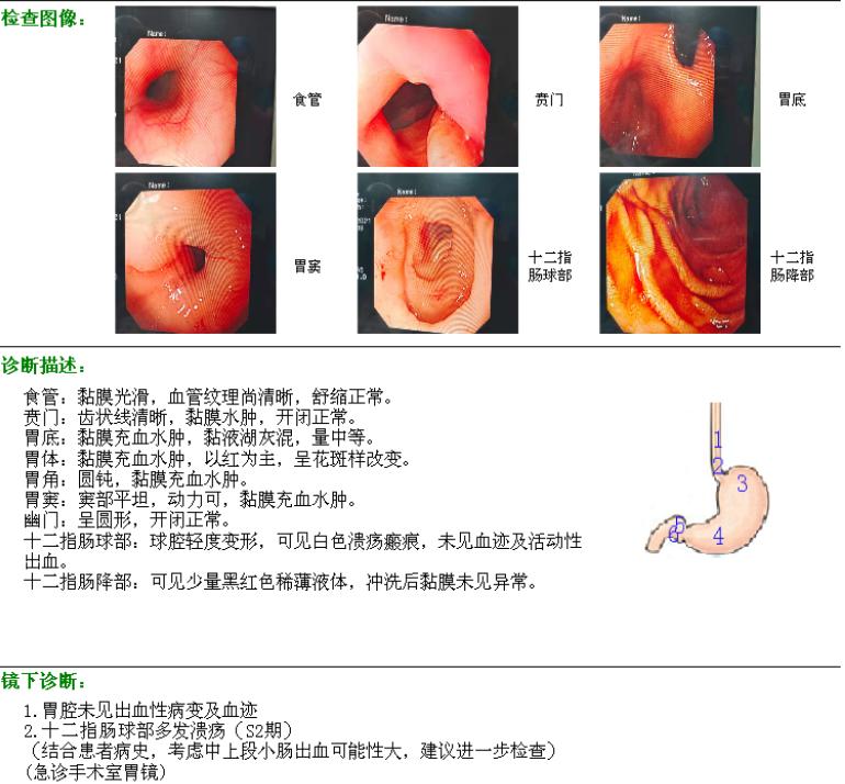 反复呕血、黑便数天，止血药物无效……到底是(图2)