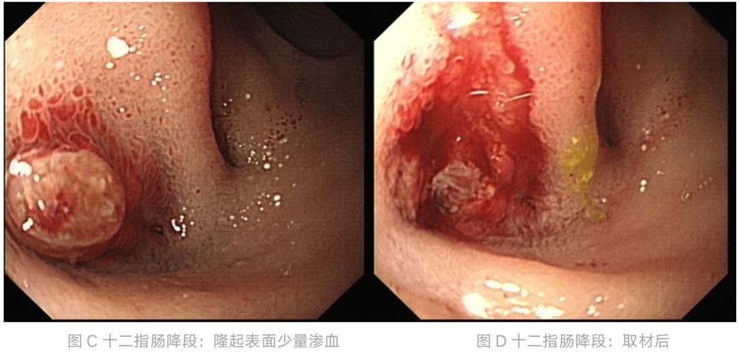 一例来势汹汹的“消化道出血”，这个病因早发(图4)