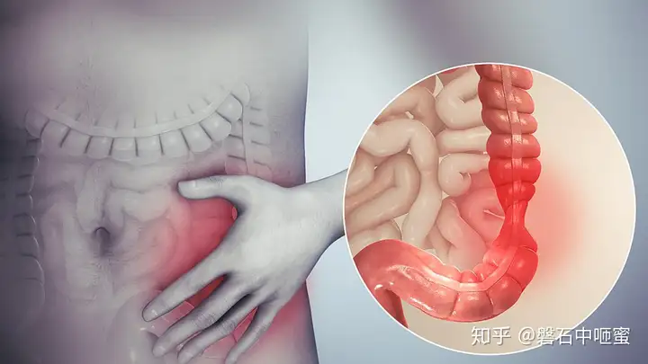 肠易激综合征 过敏性肠综合征 Irritable bowel synd(图1)