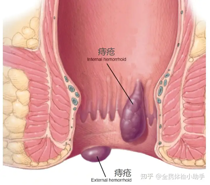 胃肠道出血的症状和原因(图1)