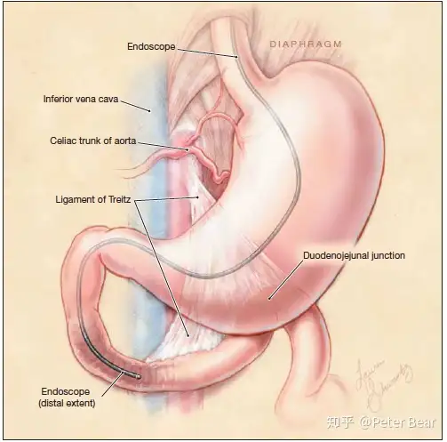 药剂师笔记之胃肠道出血（Gastrointestinal Bleed）(图1)