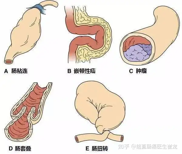 一起来认识一下肠梗阻(图2)