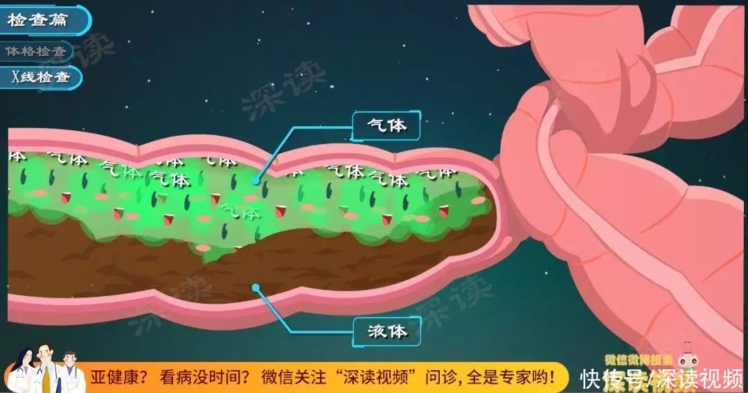 肠梗阻要断水绝食？肠道堵塞咋疏通？肠梗阻治(图2)