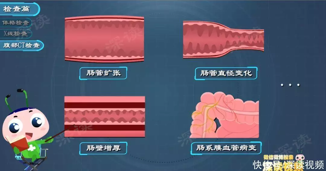 肠梗阻要断水绝食？肠道堵塞咋疏通？肠梗阻治(图3)