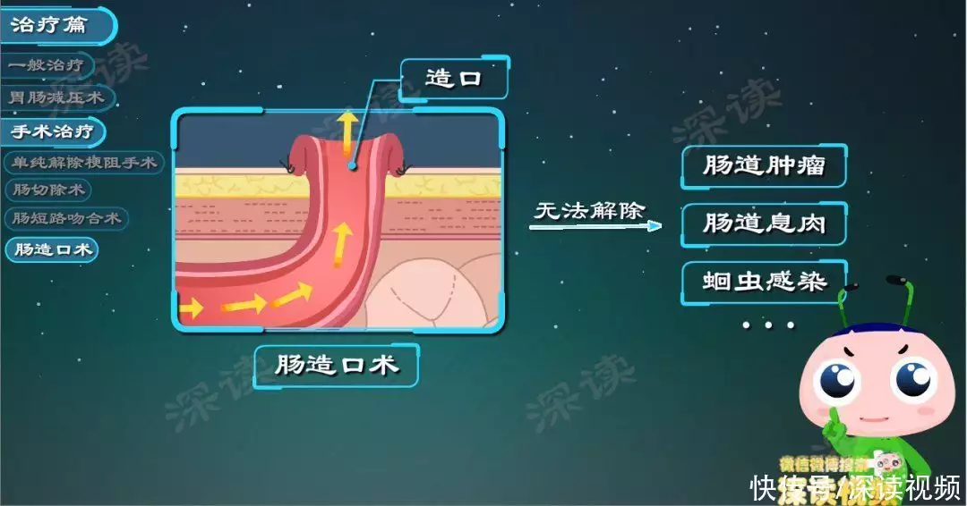 肠梗阻要断水绝食？肠道堵塞咋疏通？肠梗阻治(图7)