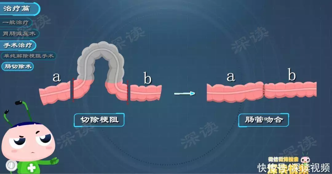 肠梗阻要断水绝食？肠道堵塞咋疏通？肠梗阻治(图6)