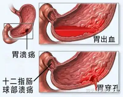 胃溃疡，五个方法改善！(图1)