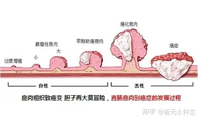 肠息肉要怎样去预防呢？(图1)