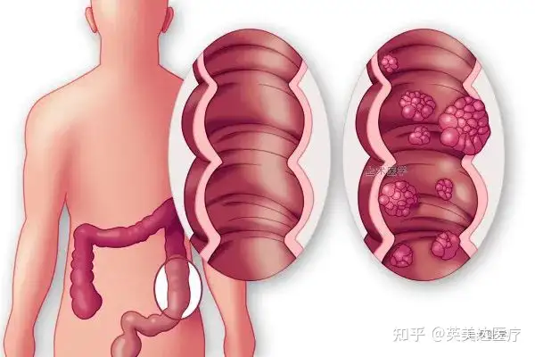 扩散 | 多点“肠”识，生活中怎样预防大肠癌？(图1)