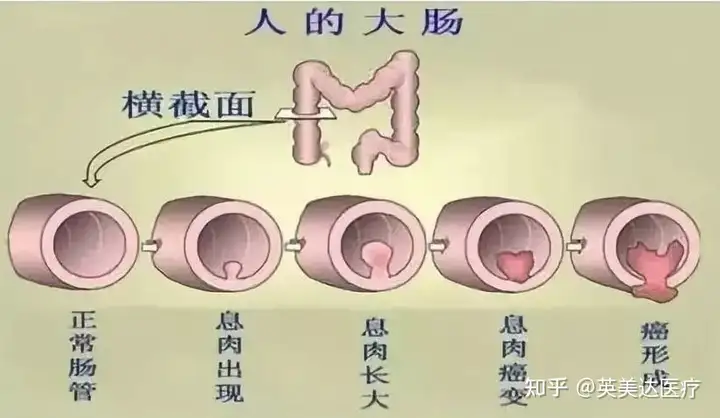 扩散 | 多点“肠”识，生活中怎样预防大肠癌？(图2)