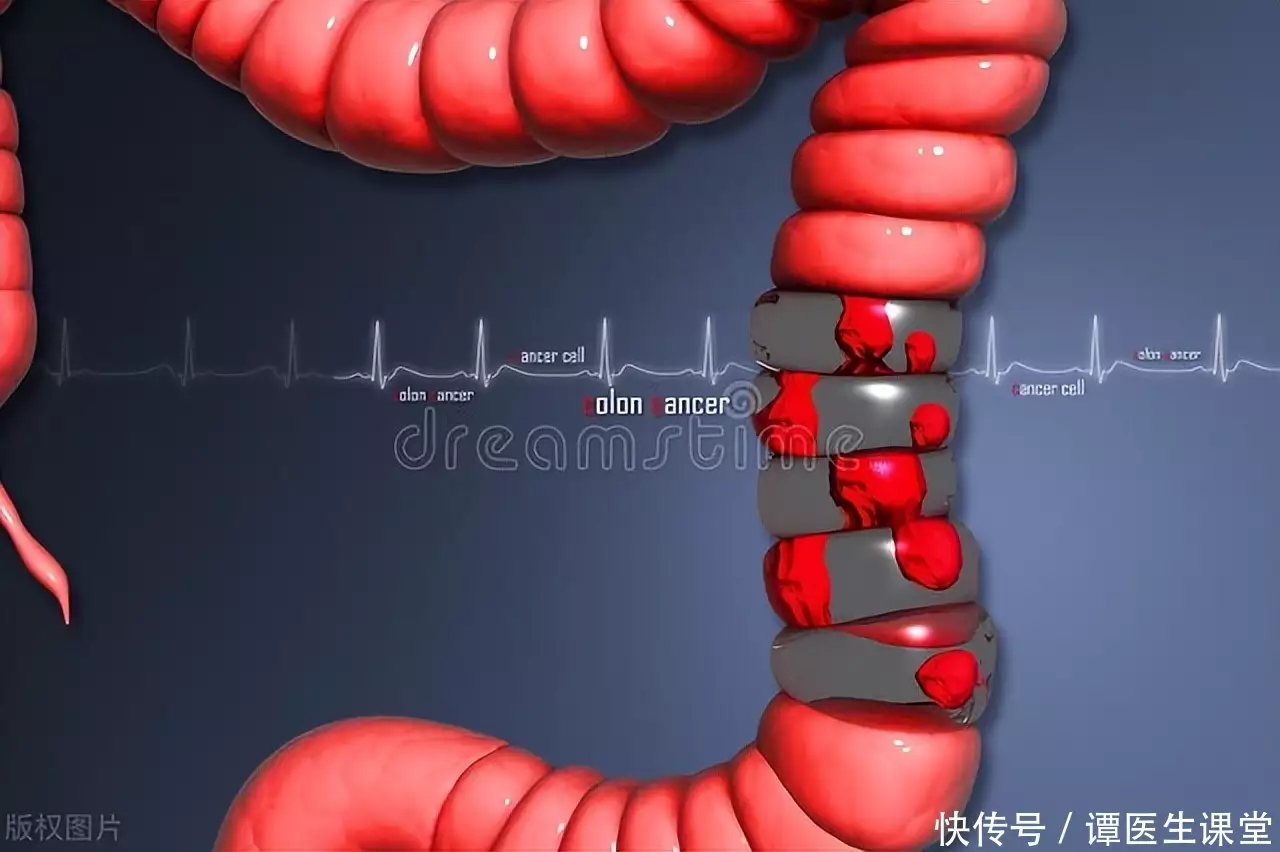 肠癌是“拖”出来的？身体有3种异常，赶紧做这(图7)