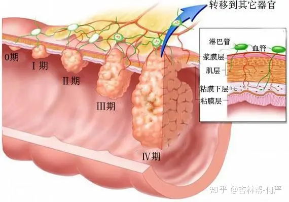 什么是大肠癌？大肠癌和结肠癌、直肠癌之间是(图4)