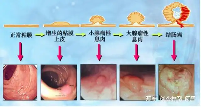 什么是大肠癌？大肠癌和结肠癌、直肠癌之间是(图3)