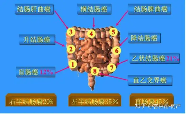 什么是大肠癌？大肠癌和结肠癌、直肠癌之间是(图2)