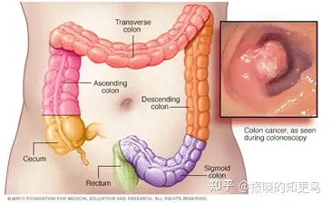 关于大肠癌科普的那些事儿(图1)