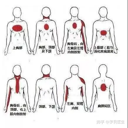 心绞痛是什么？带您全面解析心绞痛，建议收藏(图2)