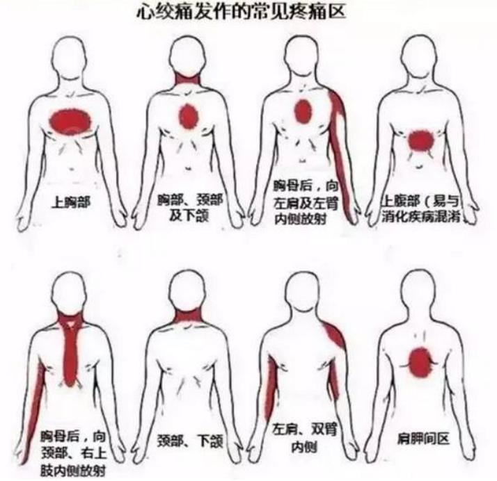 这种疼法才是心绞痛，别再搞错了！掌握五步急(图3)