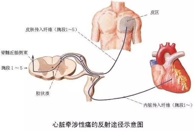 这种疼法才是心绞痛，别再搞错了！掌握五步急(图4)