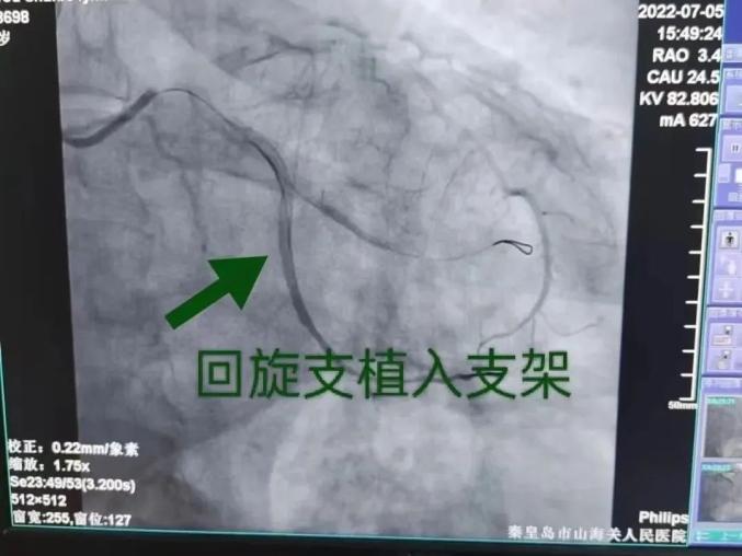 64岁男子突发心绞痛 山海关人民医院医护接力上(图2)