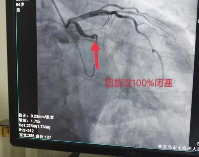 64岁男子突发心绞痛 山海关人民医院医护接力上(图1)