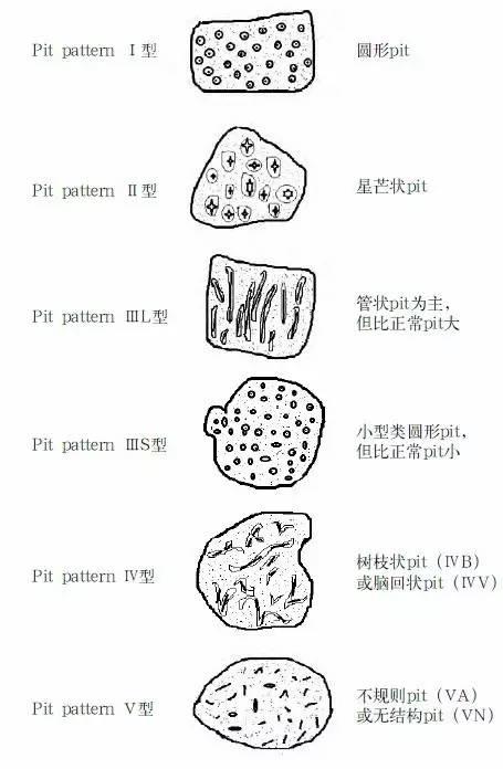 早期结直肠癌如何处理？(图4)