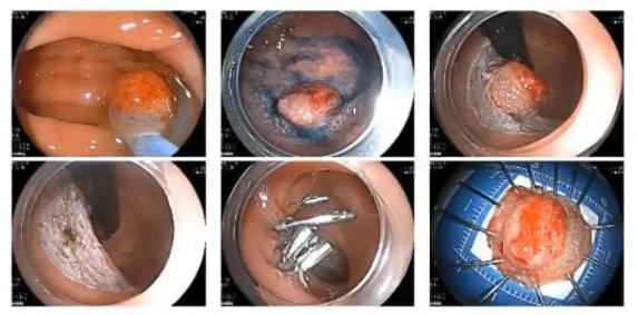 早期结直肠癌如何处理？(图1)