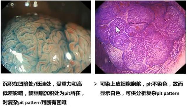 早期结直肠癌如何处理？(图7)