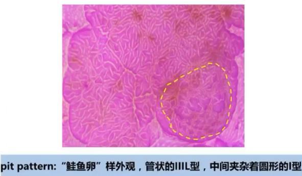 早期结直肠癌如何处理？(图9)