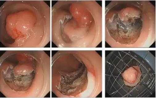 早期结直肠癌如何处理？(图16)