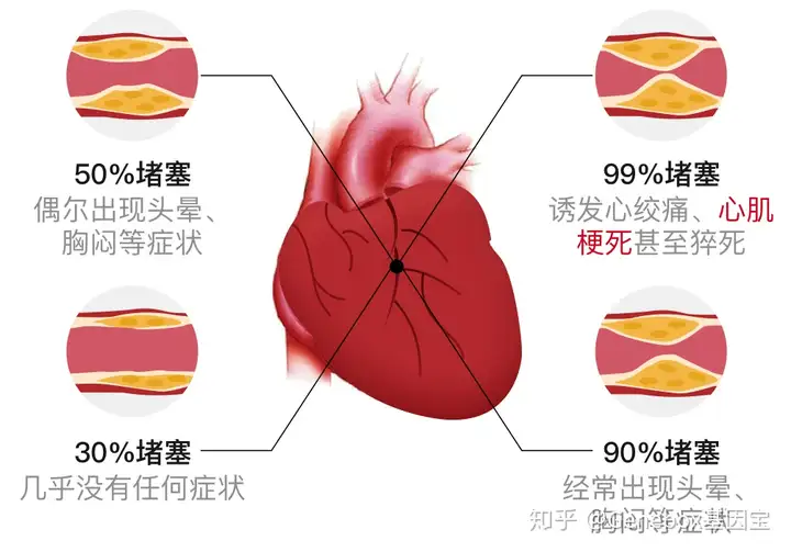 「心肌梗死」的发病原因包括哪些，有哪些先兆(图1)