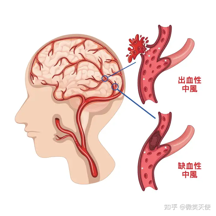 健康杀手——脑卒中(认识篇)(图1)