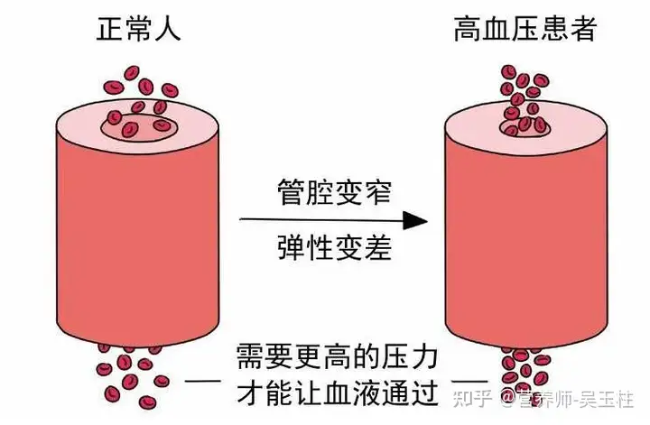 什么是高血压(图1)