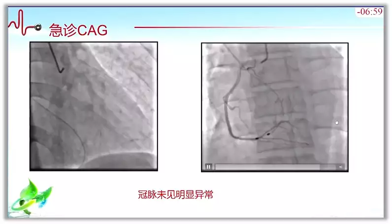 突破心律失常药物治疗瓶颈 临床典型病例提升诊(图2)