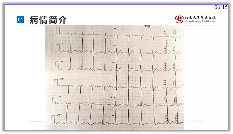 突破心律失常药物治疗瓶颈 临床典型病例提升诊(图3)