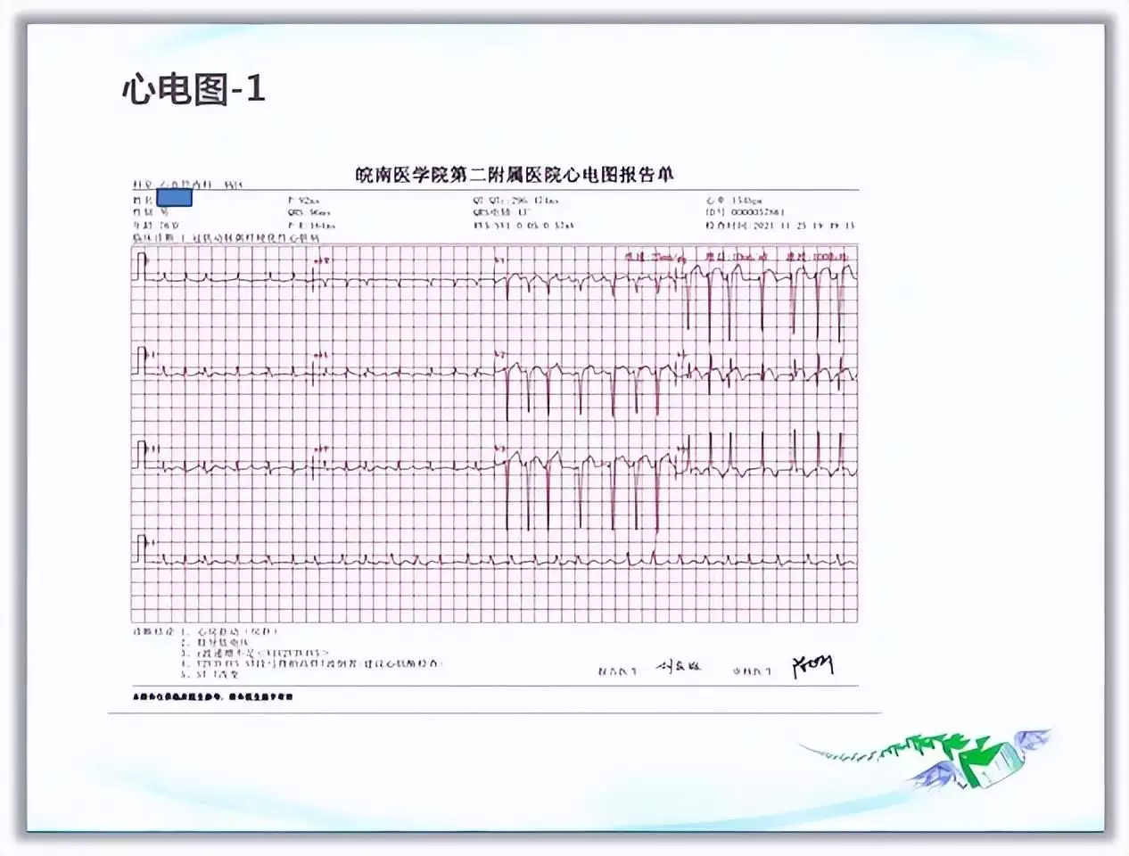 突破心律失常药物治疗瓶颈 临床典型病例提升诊(图5)