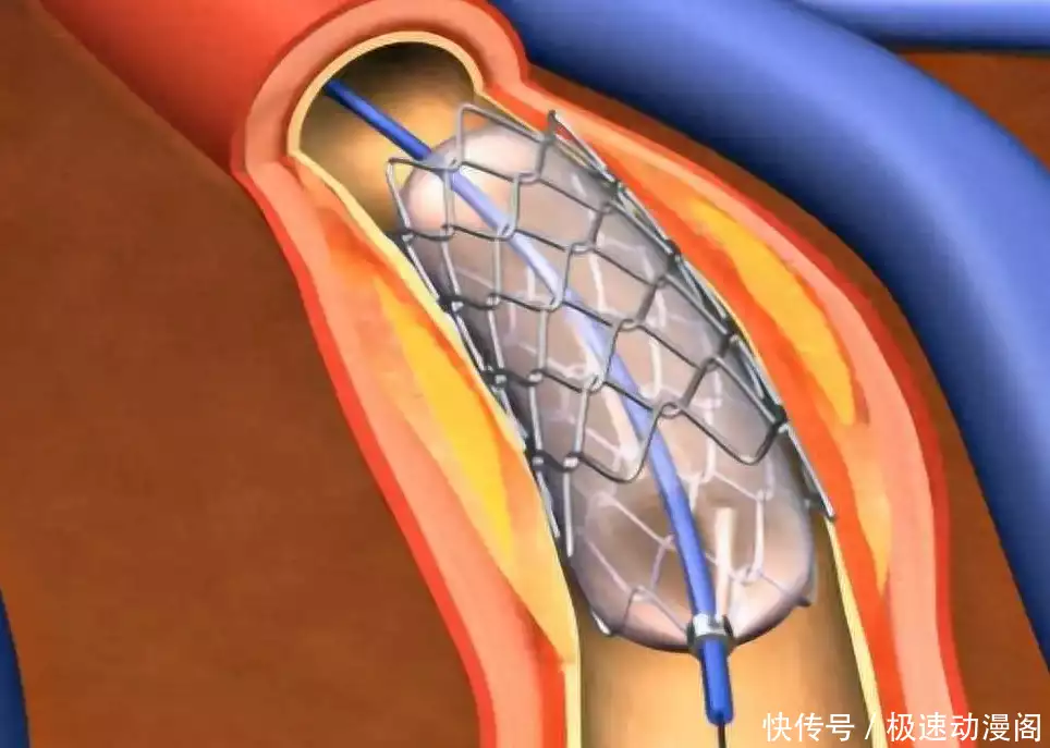 冠心病放了支架，就可以不吃药了吗？不，至少(图1)