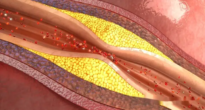 什么是动脉粥样硬化？它的危害到底有多大？是(图1)