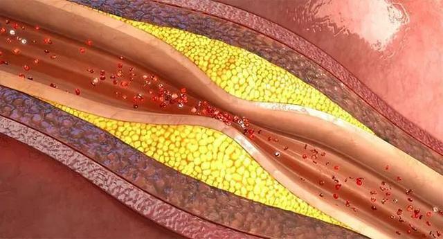 动脉硬化可以预防甚至逆转！警惕这四个阶段的(图1)