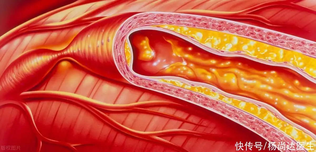 动脉硬化斑块能够逆转消失吗？医生支几招，预(图2)