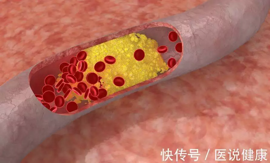 动脉硬化患者，日常需注意这3件事，或能帮你有(图5)