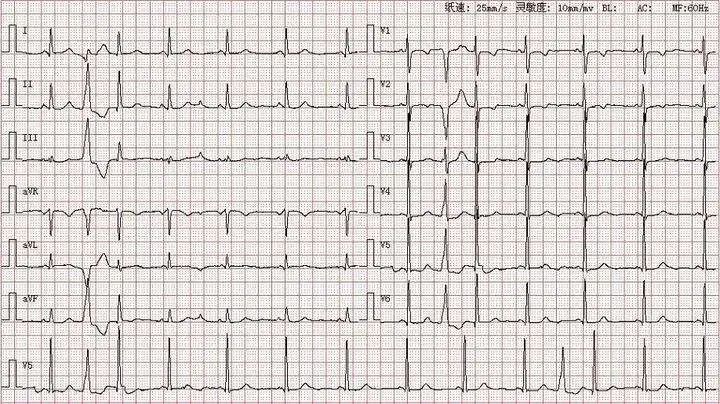 心律失常与结促代缓(图2)