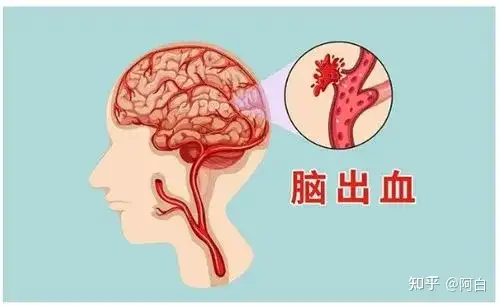 什么是脑出血？脑出血的知识你都了解吗？(图1)