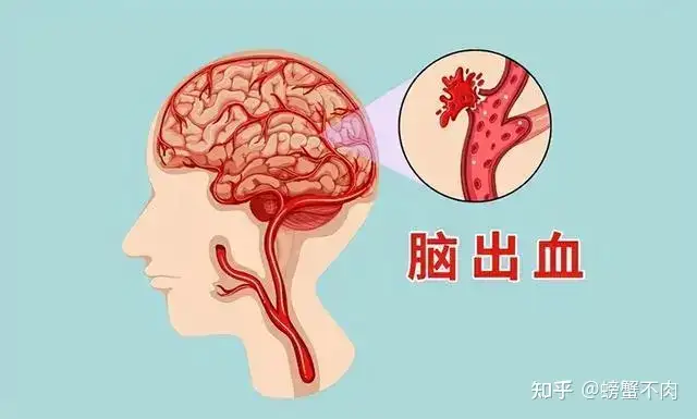 什么是脑出血？(图1)